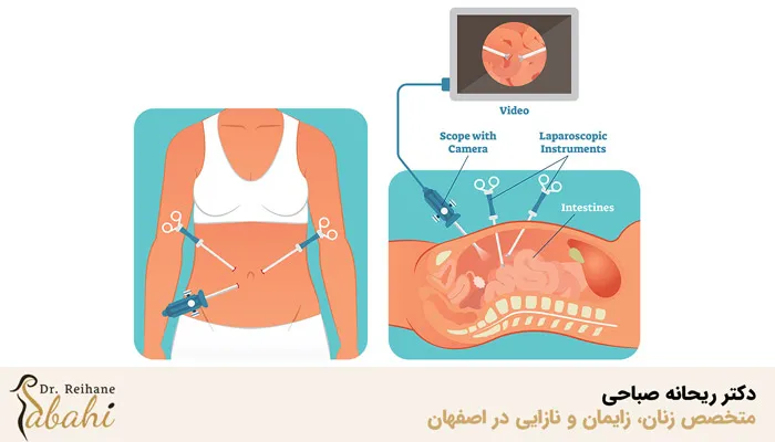 کاربردهای لاپاراسکوپی تخمدان و رحم