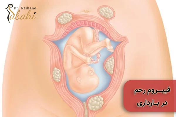 فیبروم رحم در بارداری