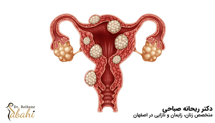 نمونه ای از فیبروم رحم