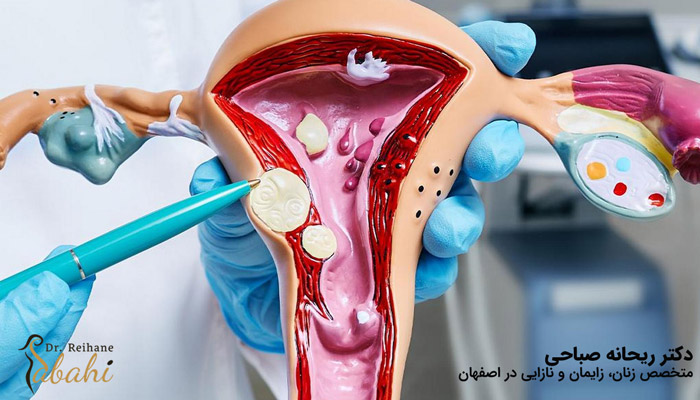 درمان صحیح با تشخیص تفاوت فیبروم رحم و پولیپ رحم